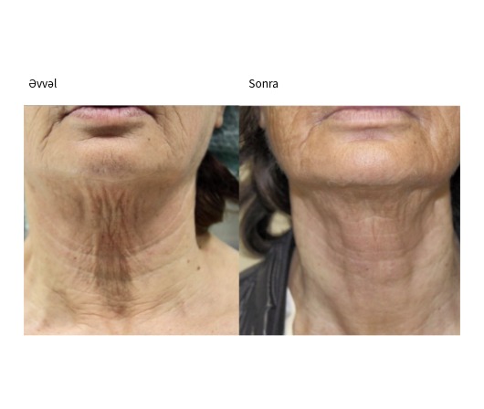 Classys Ultraformer III